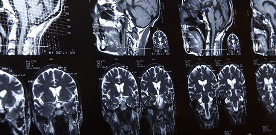 Traumatic Brain Injury